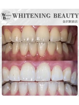 ホワイトニングビューティー 金沢駅前店(WHITENING BEAUTY)/短期間で真っ白に!