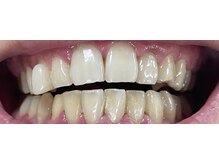 ニカ(NiCA)の雰囲気（セルフホワイトニング20分2照射、最高24トーンアップされた方も!）