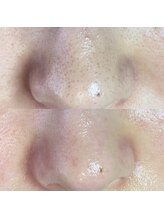 ミーミー 多治見店(MeMe.)/毛穴エクストラクション