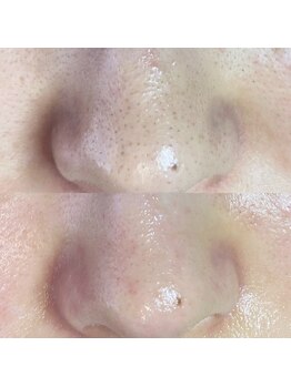 ミーミー 多治見店(MeMe.)/毛穴エクストラクション