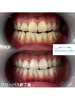 ホワイトニングサロン 熊本店/誰でもセルフホワイトニング