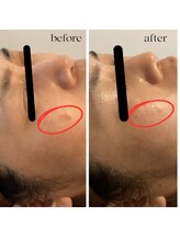 ユルリ(YURURI)/ビフォーアフター（シミケア）