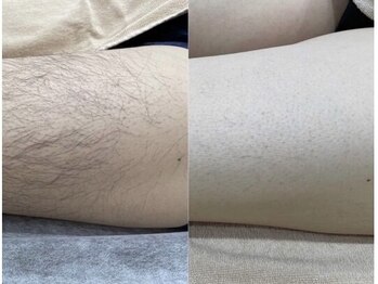 エピア 西尾店(Epia)/【脱毛 】ひざ上