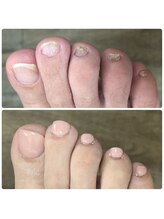 ブルームーンネイルズ(BLOOMOON.nails)/巻き爪などの痛みご相談ください