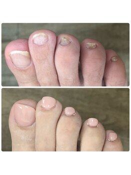 ブルームーンネイルズ(BLOOMOON.nails)/巻き爪などの痛みご相談ください