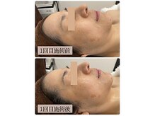 リノン(LINON)/ウィンバック 施術回数１回