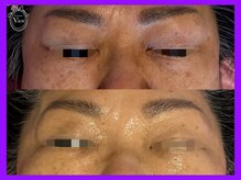 ヴィオール 名古屋栄店(VIOR)/光Vショット施術　シワ改善