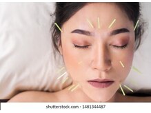 ほぐせる スター鍼灸接骨整体院 竹ノ塚 竹ノ塚東口駅前店/美容鍼