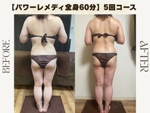 ルカ 北堀江(Luca)/ブライダル痩身☆上半身ケア