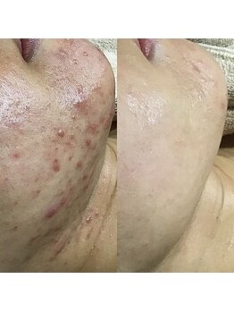 エヌエー(na)/肌質改善・ニキビケア