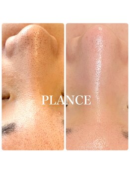プランス 熊本(PLANCE)/毛穴ケアはプロにお任せ！