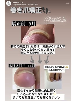 モアナ 前橋店(Moana)/巻き爪