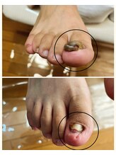 ドクターネイル爪革命 麻布十番店/【肥厚爪ケア】フットケア