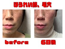 みき接骨院/姫路初ダーマ美容鍼＋ヒト幹細胞