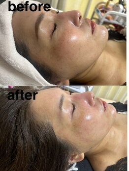 マホロバ(mahoroba)/美容鍼×ダーマ鍼