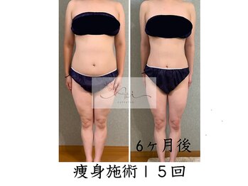 アイ エステサロン(Ai)/【30代】産後ダイエット成功♪