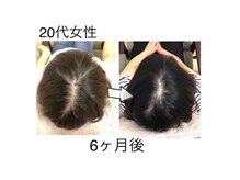 かがわ接骨院 高松伏石院/頭皮トラブルでお悩みの方！