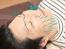 しまうら鍼灸院/美容鍼