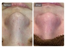 エミルカ 宮崎店(EMILUCA)/【クーポン有】毛穴を綺麗にケア