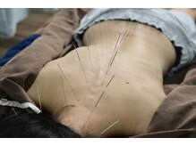 北京堂鍼灸首里 いじゅ治療院/首～腰へ脊柱起立筋にしっかり鍼