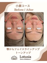 ルトゥーシア(Lotusia)/小顔　　before→after