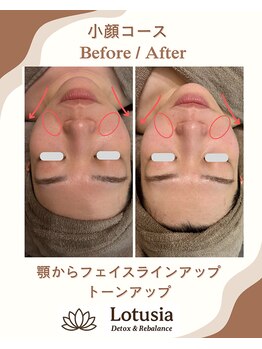 ルトゥーシア(Lotusia)/小顔　　before→after