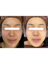 オアシス 一宮(Oasis)/最強美肌コース♪