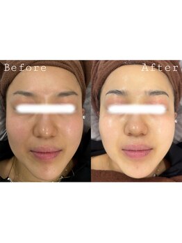 オアシス 一宮(Oasis)/最強美肌コース♪