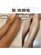 ビビユー(bibi u)/足 光脱毛ビフォーアフター