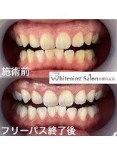 ホワイトニングサロン 京都烏丸店/ホワイトニング施術例