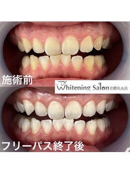 ホワイトニングサロン 京都烏丸店/ホワイトニング施術例