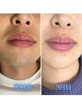 ナウザ 高崎店(NAUZA)/鼻下/あご/口周り Before・After