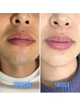 ナウザ 高崎店(NAUZA)/鼻下/あご/口周り Before・After