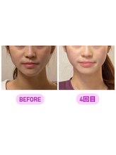 小顔22 ボルティ 本店(Bolty)/【悩み】面長