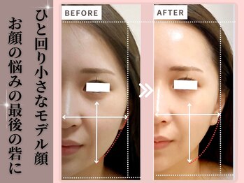 リッツ(RITZ)/【小顔矯正＋肌質改善】症例写真
