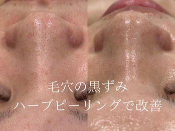 ラシュール(Rassure)/ビオフィートberore/after