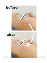 ナルフロウ(nalufurou)/お肌に優しいハーブピーリング♪