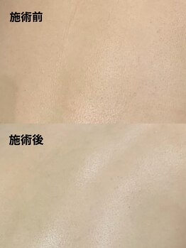 ツール(TOOL)/ハーブピーリング