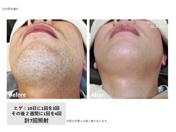 ラキュア(La Cure)/ひげ脱毛はお顔全体に照射/美肌