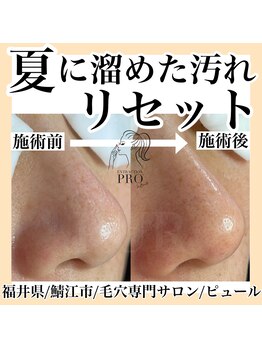 ピュール 鯖江店(PUR)/毛穴サロン/毛穴ケア/毛穴洗浄