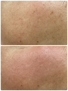 ギャラクシービューティー(galaxy beauty)/光フェイシャル