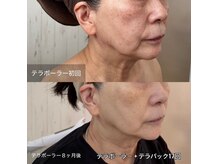 リアプア(Li'a)/たるみ改善しすっきりした肌へ