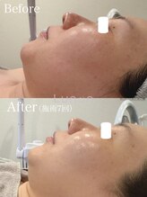 ルノン(Lunon)/毛穴洗浄ハイドロ×ララピール