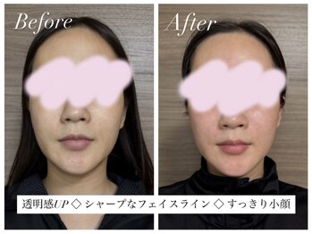 ヨサパーク リリア 立川北口店(YOSA PARK Lylia)/【小顔】一度でこの変化♪