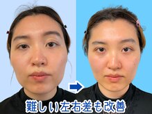 ナチュラルパーフェクトフェイス 新宿/強い左右差改善/新宿小顔矯正店