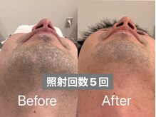 ラトリエ(L'Atelier)/ヒゲ脱毛5回 ビフォー/アフター