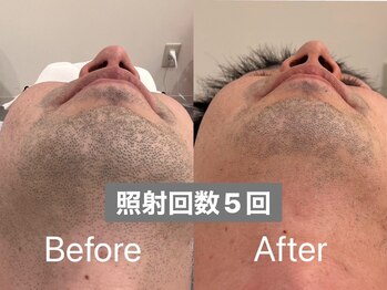 ラトリエ(L'Atelier)/ヒゲ脱毛5回 ビフォー/アフター