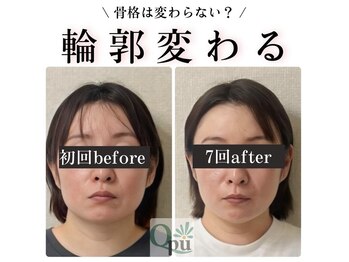 キュープ 鹿児島伊集院店(Qpu)/小顔頭矯正4回での変化