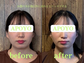 アポヨ鍼灸院(APOYO鍼灸院)/美容鍼×体鍼整体　before/after