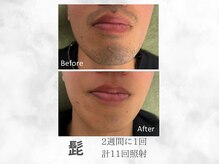 ベル(Belle)/メンズヒゲ脱毛